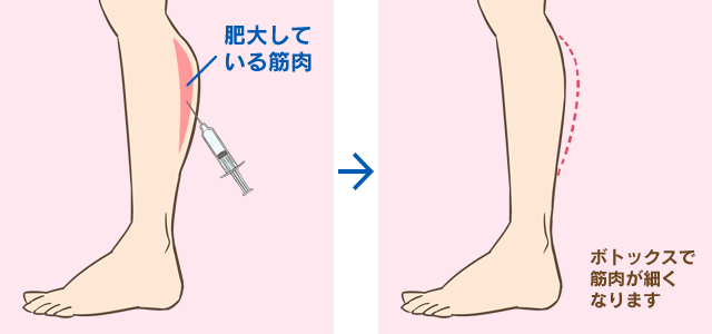 切らない痩身治療 ボトックスふくらはぎ ボディライン 美容外科 美容整形のサラ美容外科愛知県 名古屋 脂肪吸引 豊胸 二重 レーザー脱毛 プチ整形 若返り