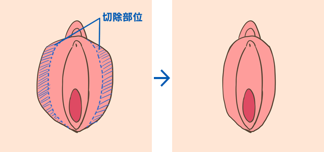 小陰唇縮小 写真