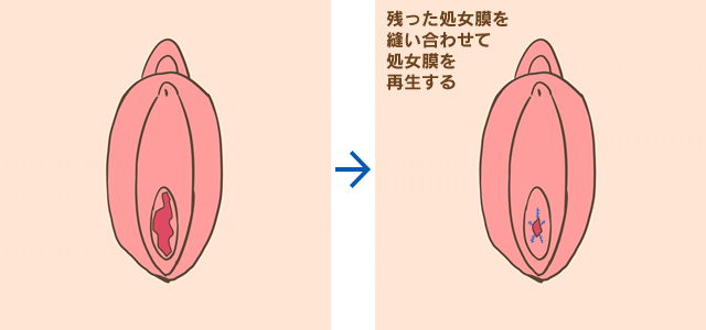 処女幕 ルクスクリニック