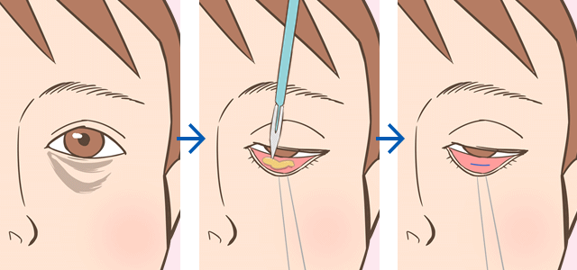 整形 目の下 の クマ