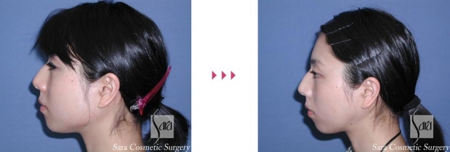 術前　　　　　　　　　　　術後