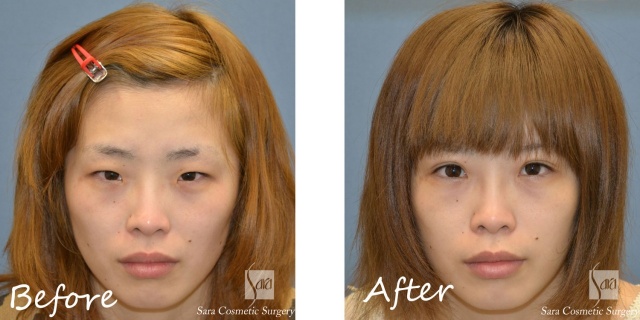 眼瞼下垂手術と目頭切開術前術後（ノーメイク）