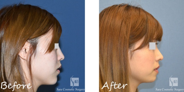 アゴの骨切りモニターAさん右側面