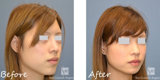 アゴの骨切りモニターAさん右斜面