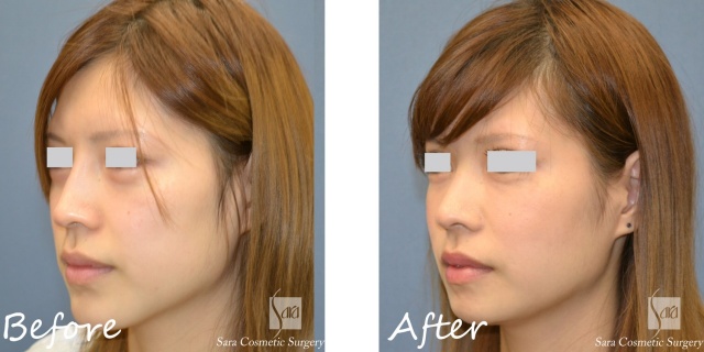 アゴの骨切りモニターAさん左斜面