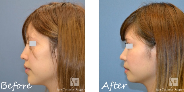 アゴの骨切りモニターAさん左側面