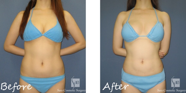 RPCスマートリポ脂肪吸引（腹部全体＋腰部）術前