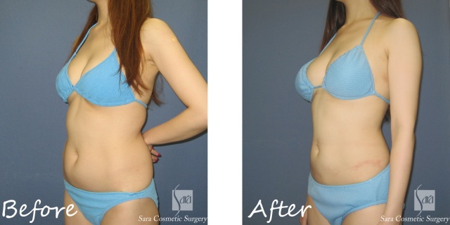 RPCスマートリポ脂肪吸引（腹部全体＋腰部）術後