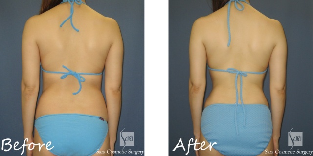 RPCスマートリポ脂肪吸引（腹部全体＋腰部）術前