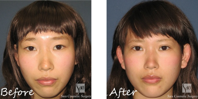 二重（全切開）＋タルミ取り術前