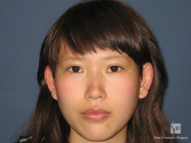 二重（全切開）＋タルミ取り手術後1ヶ月