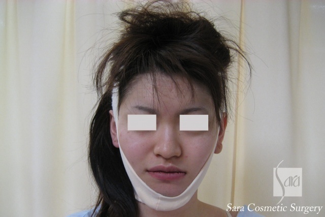 アゴ骨切り 笑うとアゴが気になるのでアゴの骨切りをしました モニター写真集 美容外科 美容整形のサラ美容外科愛知県 名古屋 脂肪吸引 豊胸 二重 レーザー脱毛 プチ整形 若返り アゴ骨切り 笑うとアゴが気になるのでアゴの骨切りをしました モニター写真集 美容外科 美容整形のサラ美容外科愛知県 名古屋 脂肪吸引 豊胸 二重 レーザー脱毛 プチ整形 若返り