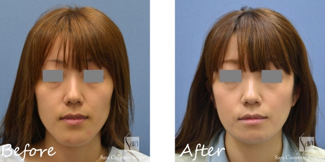 サラ美容外科　顎骨切り　ビフォーアフタ　術前術後