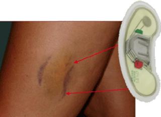 アクチパッチの効果