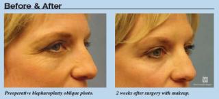 術前と術後２週目