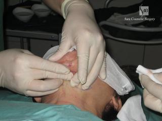 オイルを搾り出す