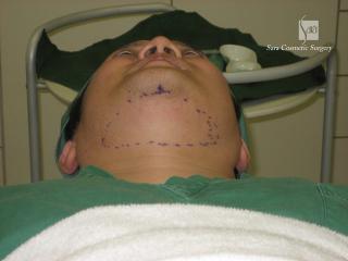 施術前のマーキング