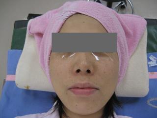 治療部位にペンレス