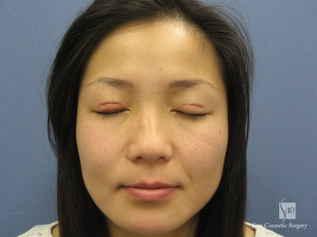 術後５日目（抜糸後）閉眼