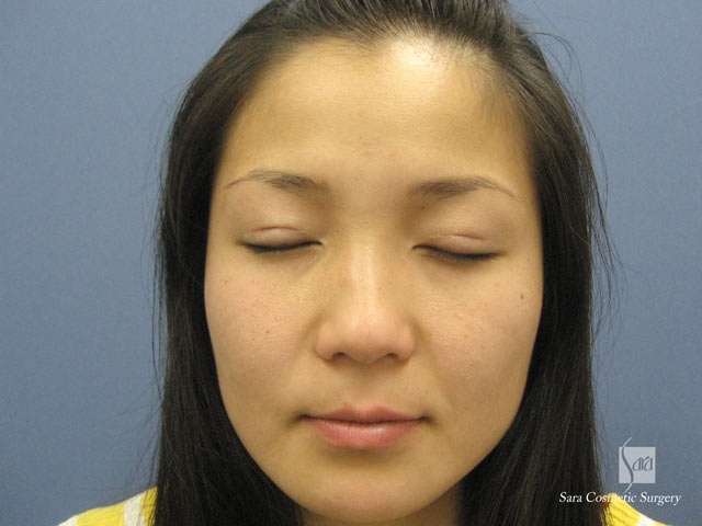 術後１ヶ月目閉眼