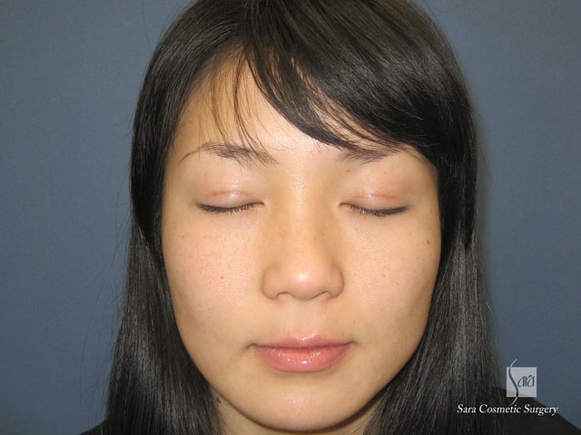 術後１ヶ月目閉眼