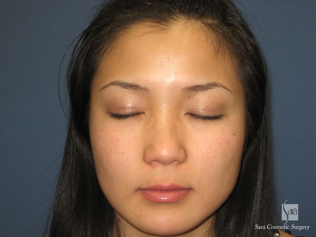 術後３ヶ月目閉眼