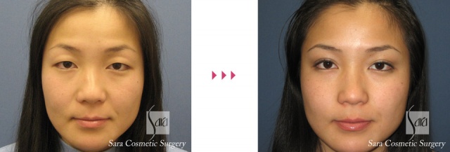 術前　　　　　　　　　　　　術後３ヶ月