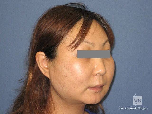 エラ削り 頬骨体部削りのモニターさん モニター写真集 美容外科 美容整形のサラ美容外科愛知県 名古屋 脂肪吸引 豊胸 二重 レーザー脱毛 プチ 整形 若返り エラ削り 頬骨体部削りのモニターさん モニター写真集 美容外科 美容整形のサラ美容外科愛知県 名古屋 脂肪吸引 豊胸 二重 レーザー脱毛 プチ 整形 若返り