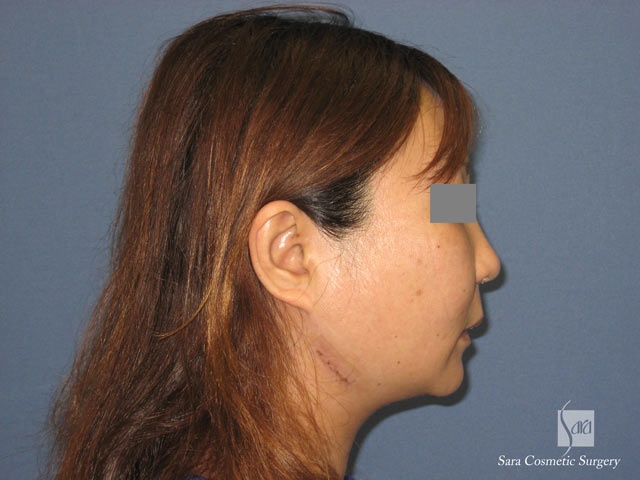 エラ削り（口外法）＋頬骨削り　術後２日目　側面