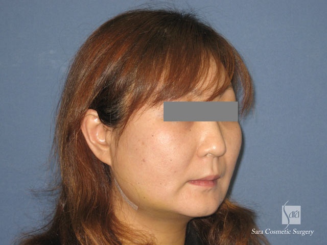 エラ削り 頬骨体部削りのモニターさん モニター写真集 美容外科 美容整形のサラ美容外科愛知県 名古屋 脂肪吸引 豊胸 二重 レーザー脱毛 プチ 整形 若返り エラ削り 頬骨体部削りのモニターさん モニター写真集 美容外科 美容整形のサラ美容外科愛知県 名古屋 脂肪吸引 豊胸 二重 レーザー脱毛 プチ 整形 若返り