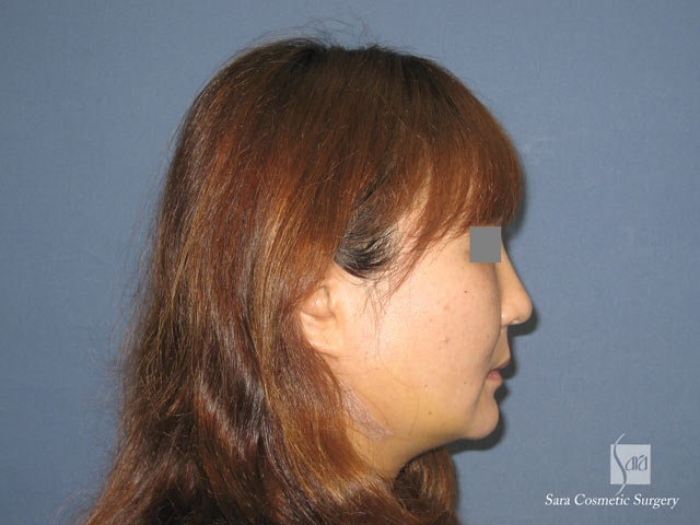 エラ削り（口外法）＋頬骨削り　術後５日目　側面