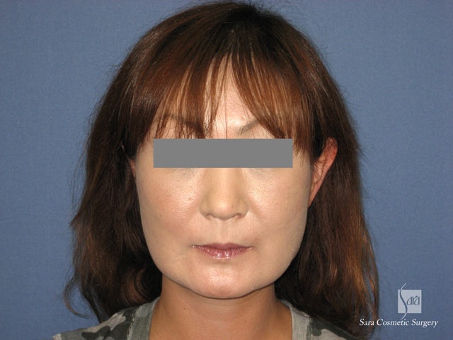 エラ削り（口外法）＋頬骨削り　術後１２日目　正面