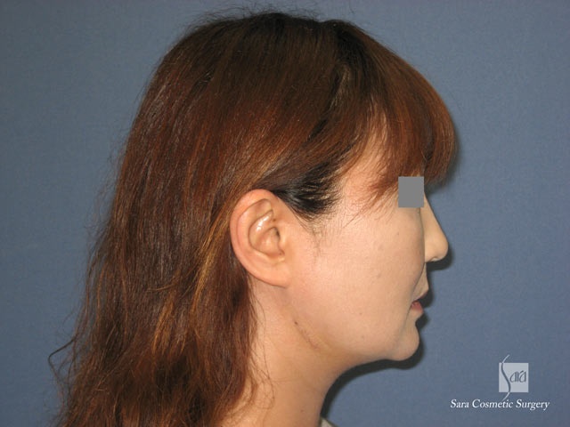 エラ削り（口外法）＋頬骨削り　術後１２日目　側面