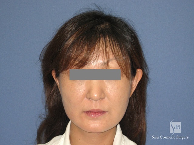 エラ削り（口外法）＋頬骨削り　術後１ヶ月　正面