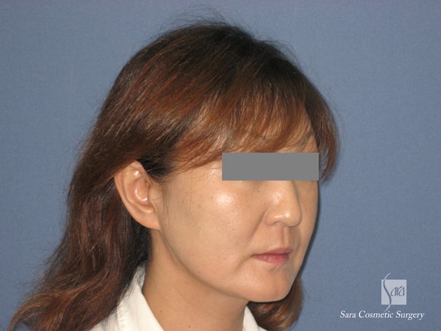 エラ削り（口外法）＋頬骨削り　術後１ヶ月　斜面