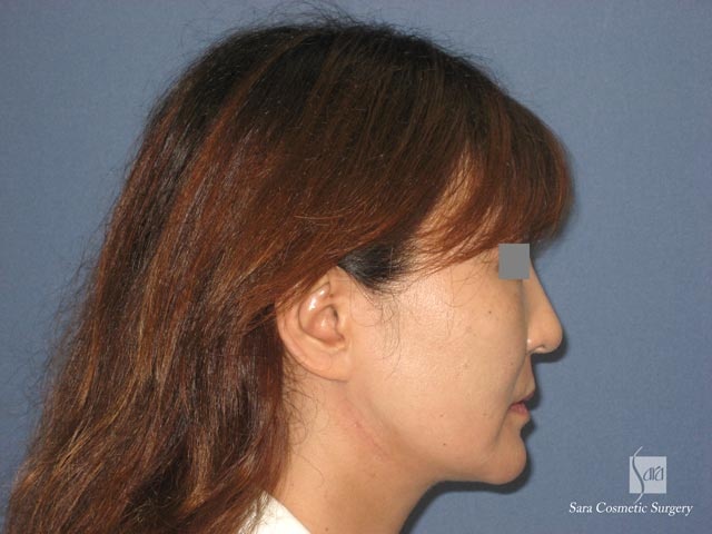 エラ削り（口外法）＋頬骨削り　術後１ヶ月　側面