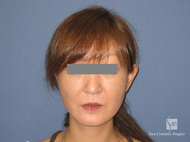 エラ削り（口外法）＋頬骨削り　術後３ヶ月　正面