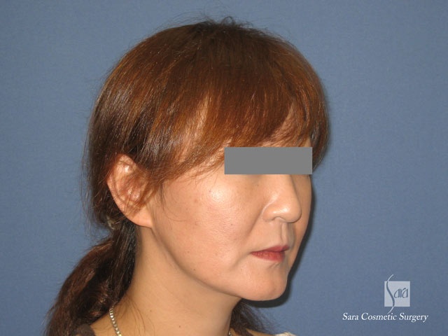 エラ削り（口外法）＋頬骨削り　術後３ヶ月　斜面