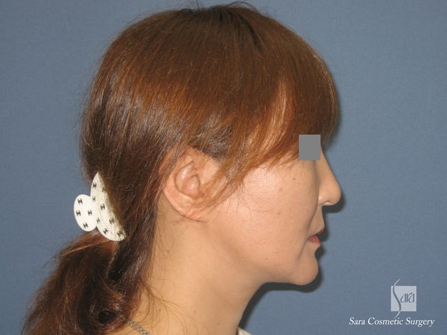 エラ削り（口外法）＋頬骨削り　術後３ヶ月　側面