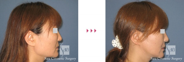 エラ削り（口外法）＋頬骨削り　術前術後　側面