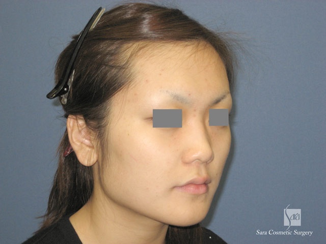 エラ削り（口外法）術前斜め