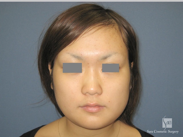 エラ削り（口外法）術後２日目正面