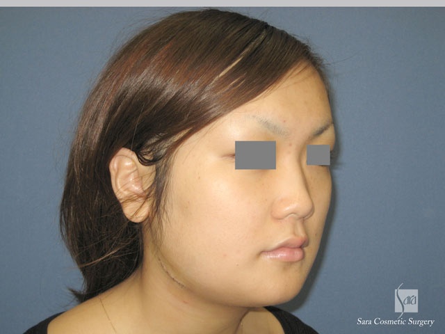 エラ削り（口外法）術後２日目斜面