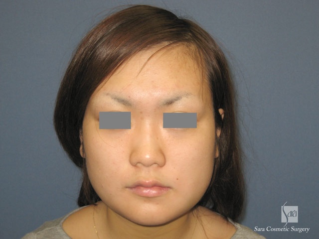 エラ削り（口外法）術後５日目正面