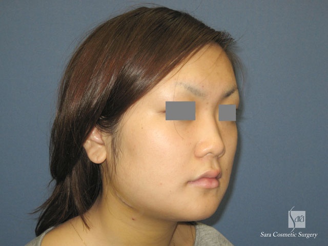 エラ削り（口外法）術後５日目斜面