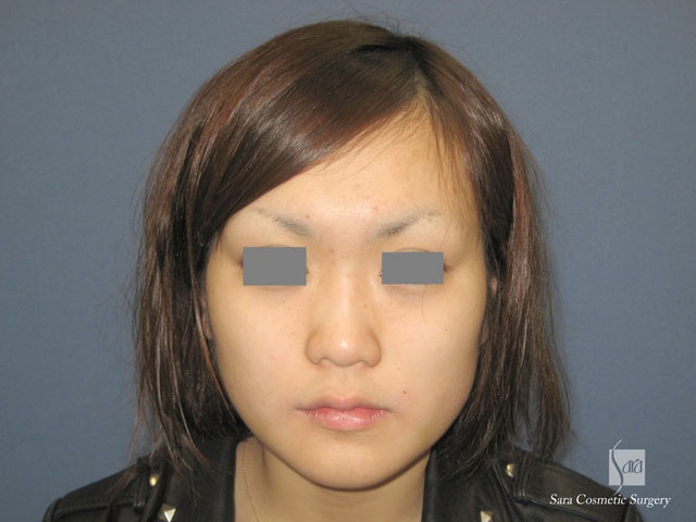 エラ削り（口外法）術後２週間正面