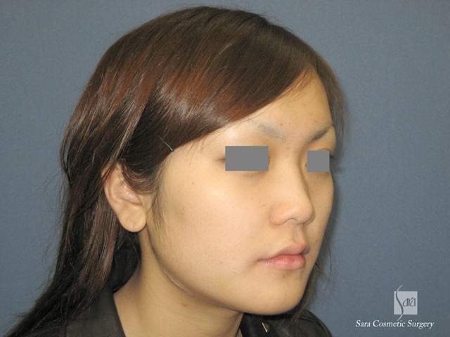 エラ削り（口外法）術後２週間斜面