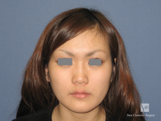 エラ削り（口外法）術後１ヶ月半正面