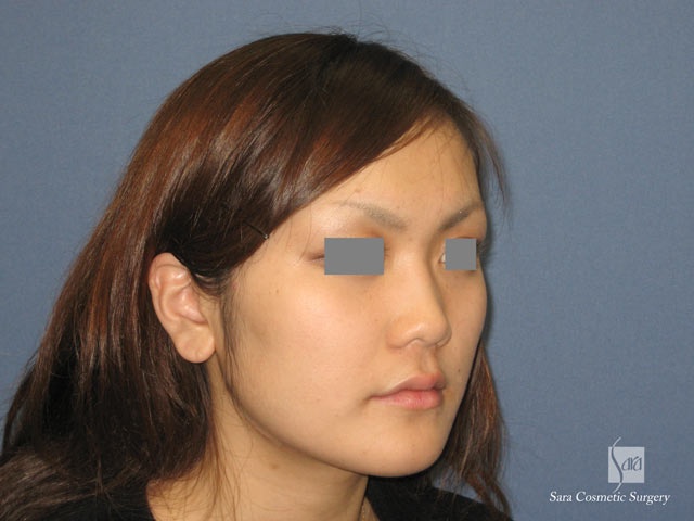 エラ削り（口外法）術後１ヶ月半正面