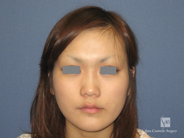 エラ削り（口外法）術後６ヶ月正面